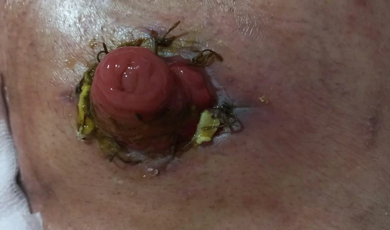 Estoma estoma