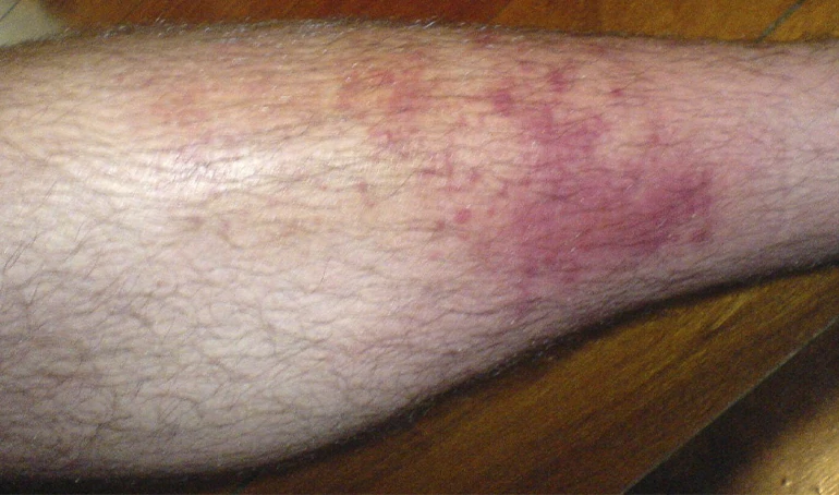 celulitis