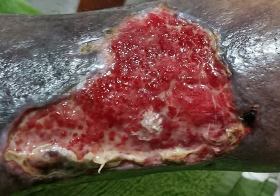 Úlcera varicosa ulcera venosa y arterial